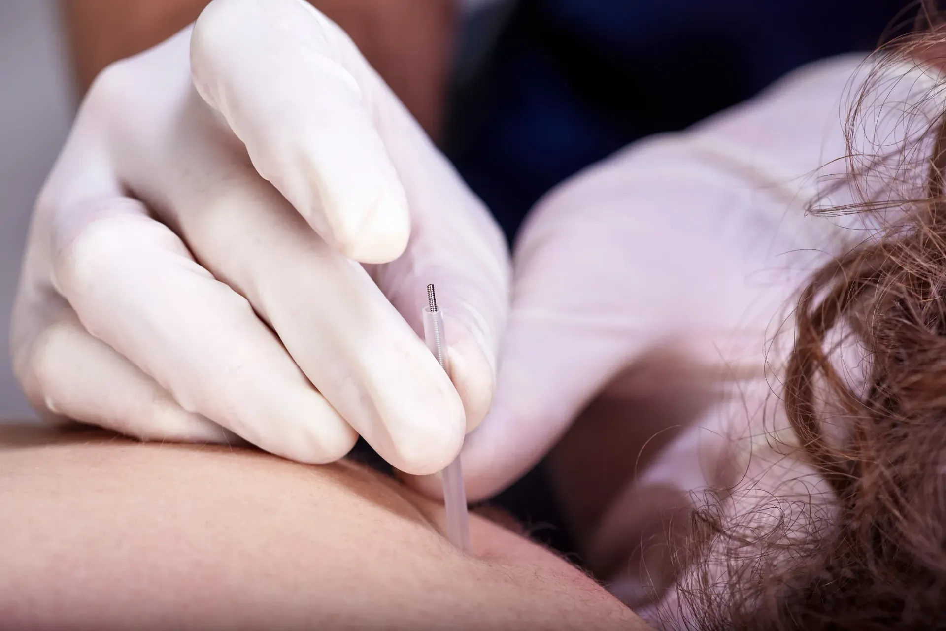 Una persona está recibiendo un tratamiento de acupuntura en su brazo.