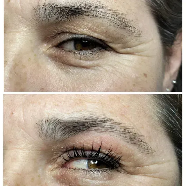 Fotografías de ojos antes y después, que muestran la reducción de arrugas después del procedimiento cosmético.