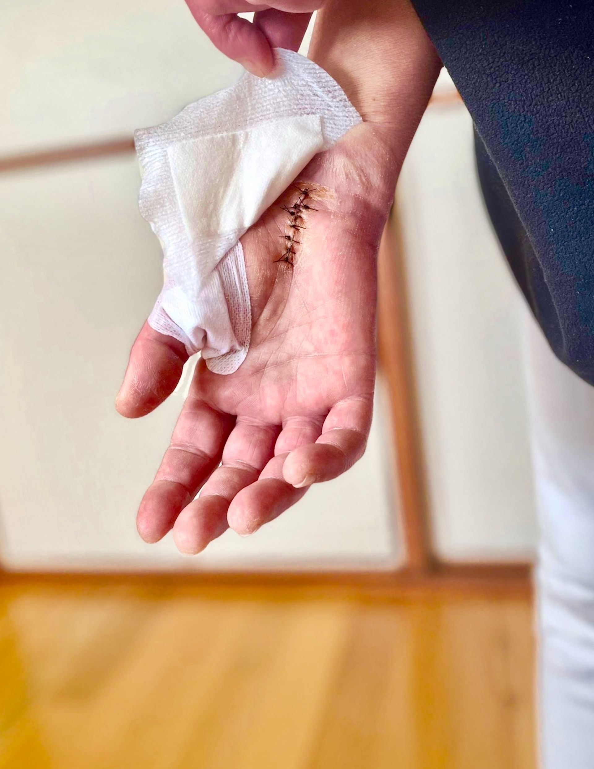 Main avec des points de suture, gaze soulevée. Murs beiges, parquet.