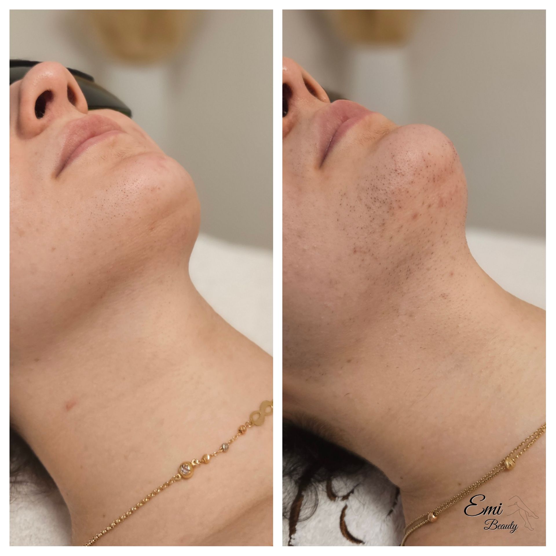 Vorher-Nachher Foto von der erfolgreicher Laserhaarentfernung am Gesicht