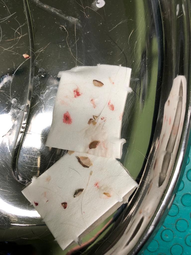 Genutzte Tupfer nach Zahn OP