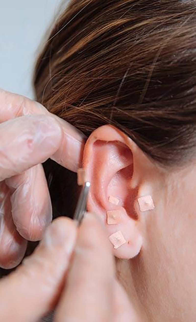 Persona recibiendo tratamiento de auriculopuntura. Una mano enguantada aplica pequeños parches en la oreja.