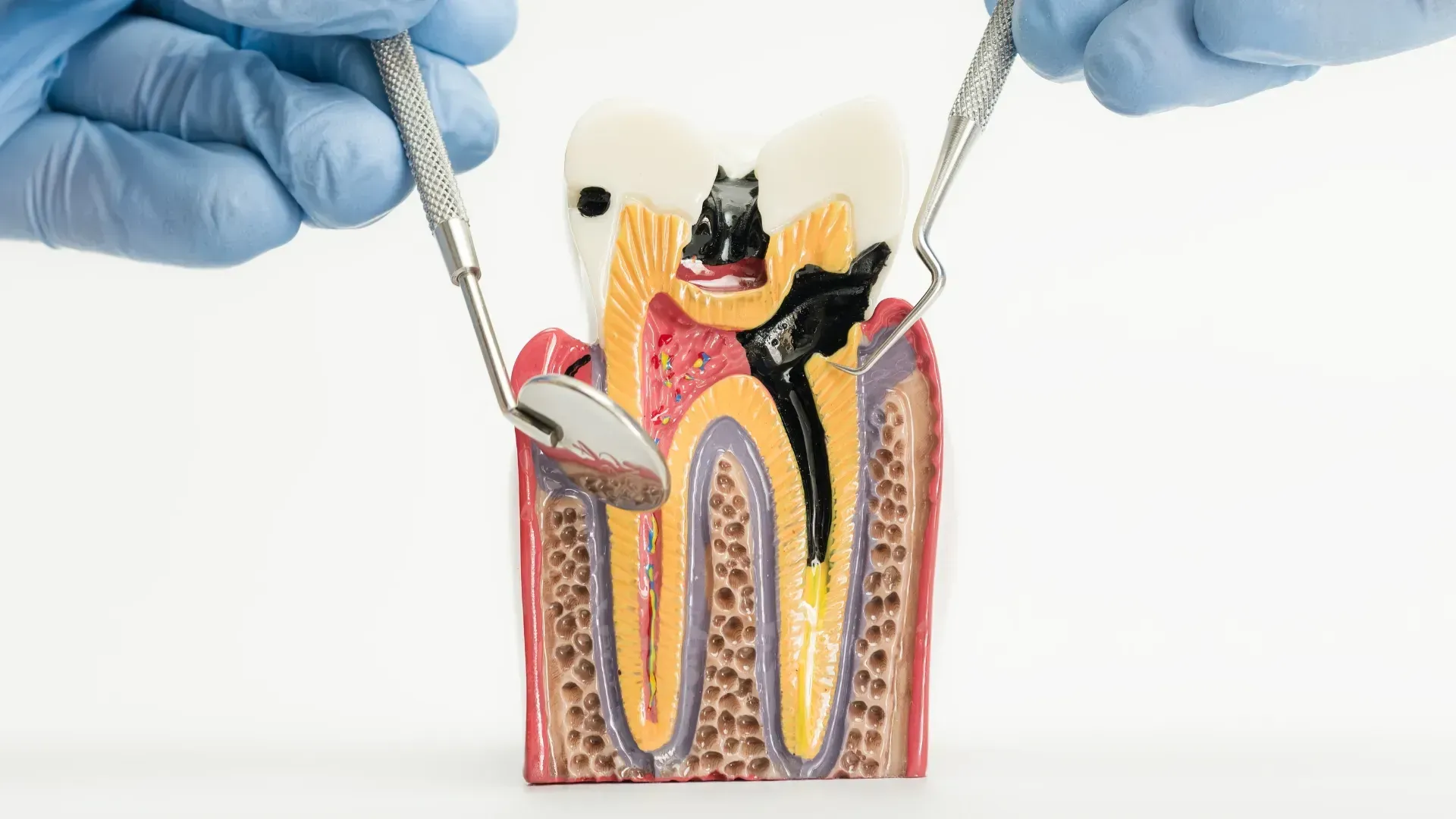 Manos con guantes azules sosteniendo herramientas dentales examinando un modelo de diente con caries.