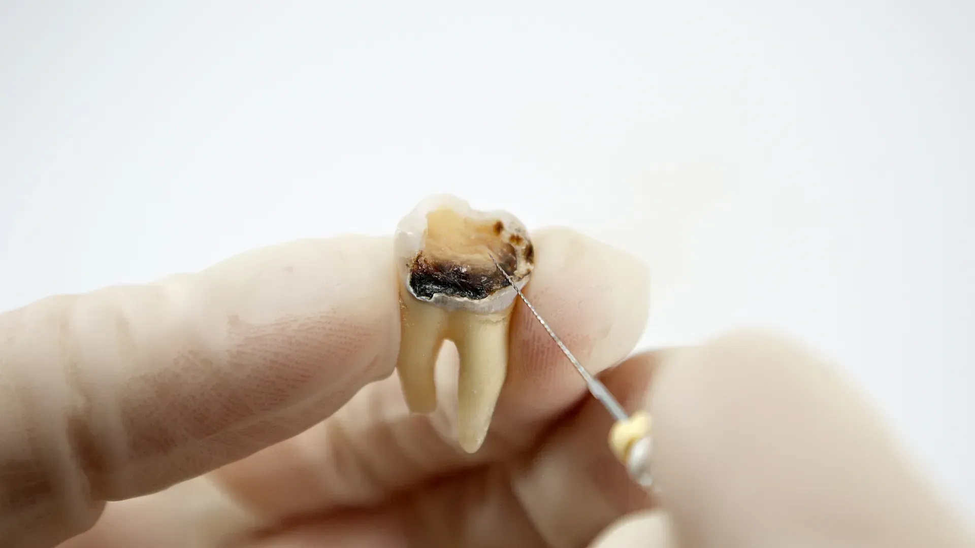 Una mano enguantada sostiene un diente gravemente cariado. Un instrumento dental apunta hacia él.