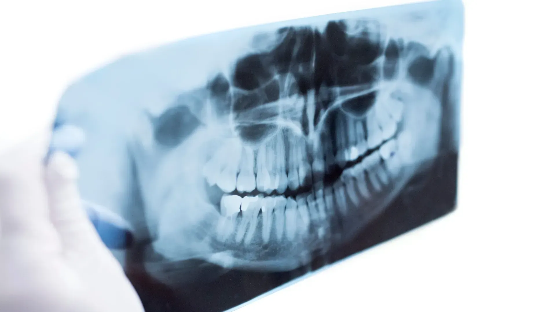 Dentista utilizando un taladro dental en el diente de un paciente.