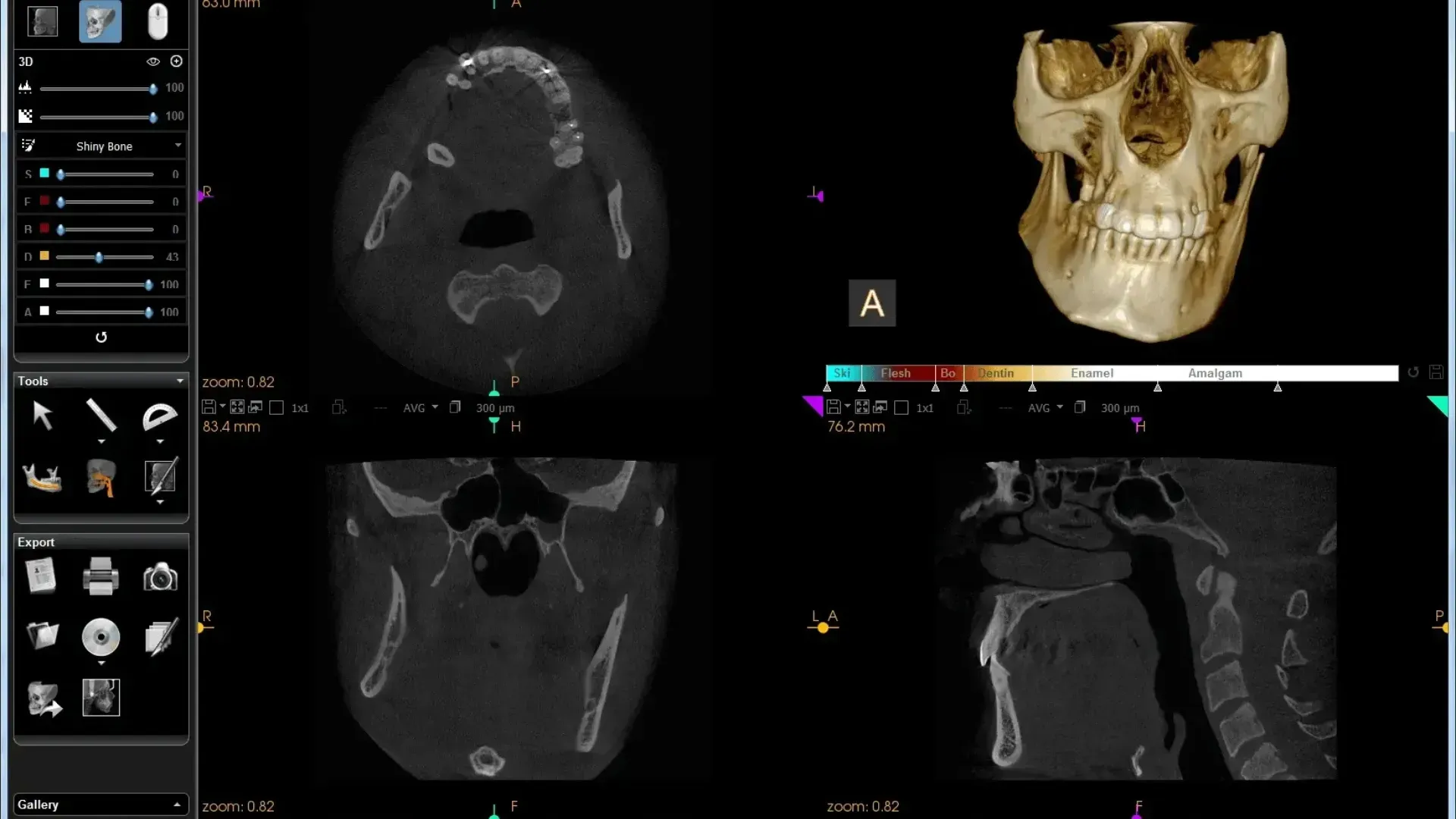 Implante dental sostenido por una mano enguantada. El implante lleva una corona dental, colocada delante de una bata blanca.