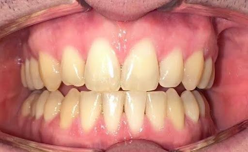Vista de cerca de dientes y encías en una boca abierta, mostrando dientes amarillentos y encías rosadas.