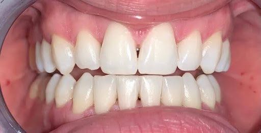Primer plano de los dientes de una persona. Dientes blancos y brillantes con encías rosadas y sanas.