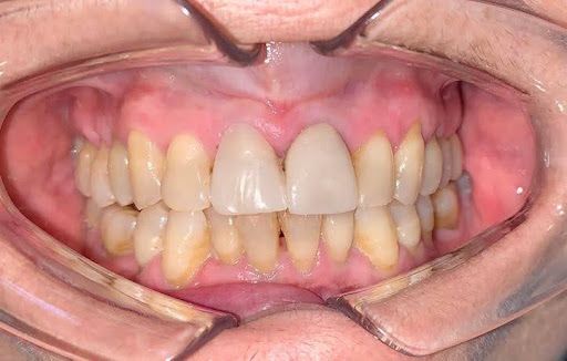 Boca con dientes mantenidos abiertos por un retractor. Dos incisivos centrales son más claros que los demás dientes.