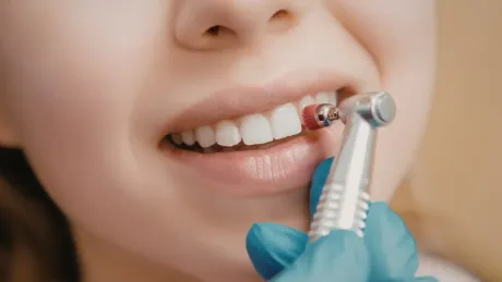 Dentista utilizando un taladro dental en el diente de un paciente.