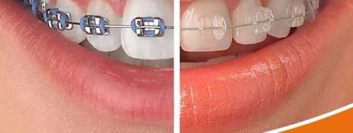 Primer plano de dos juegos de dientes con diferentes tipos de aparatos: uno con brackets metálicos y otro con brackets transparentes.