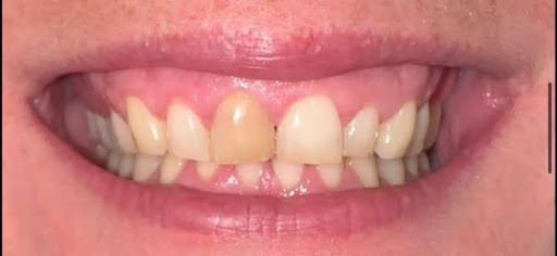 Primer plano de los dientes de una persona. Los dientes están ligeramente amarillentos, con un diente visiblemente más oscuro en el centro. Encías y labios rosados.