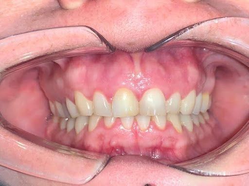 Boca con dientes expuestos por un retractor de mejillas. Se aprecian encías rosadas y dientes blancos en un entorno dental.