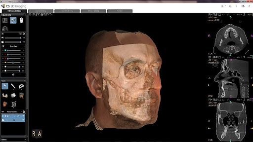 Dientes con alineador transparente en la boca, vista lateral, sobre un fondo azul.