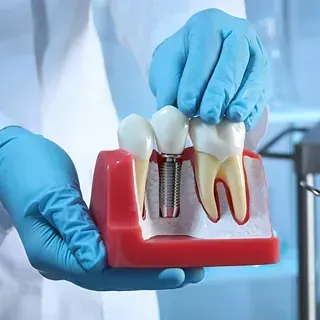 Un dentista sostiene un modelo de un diente con un implante en él.