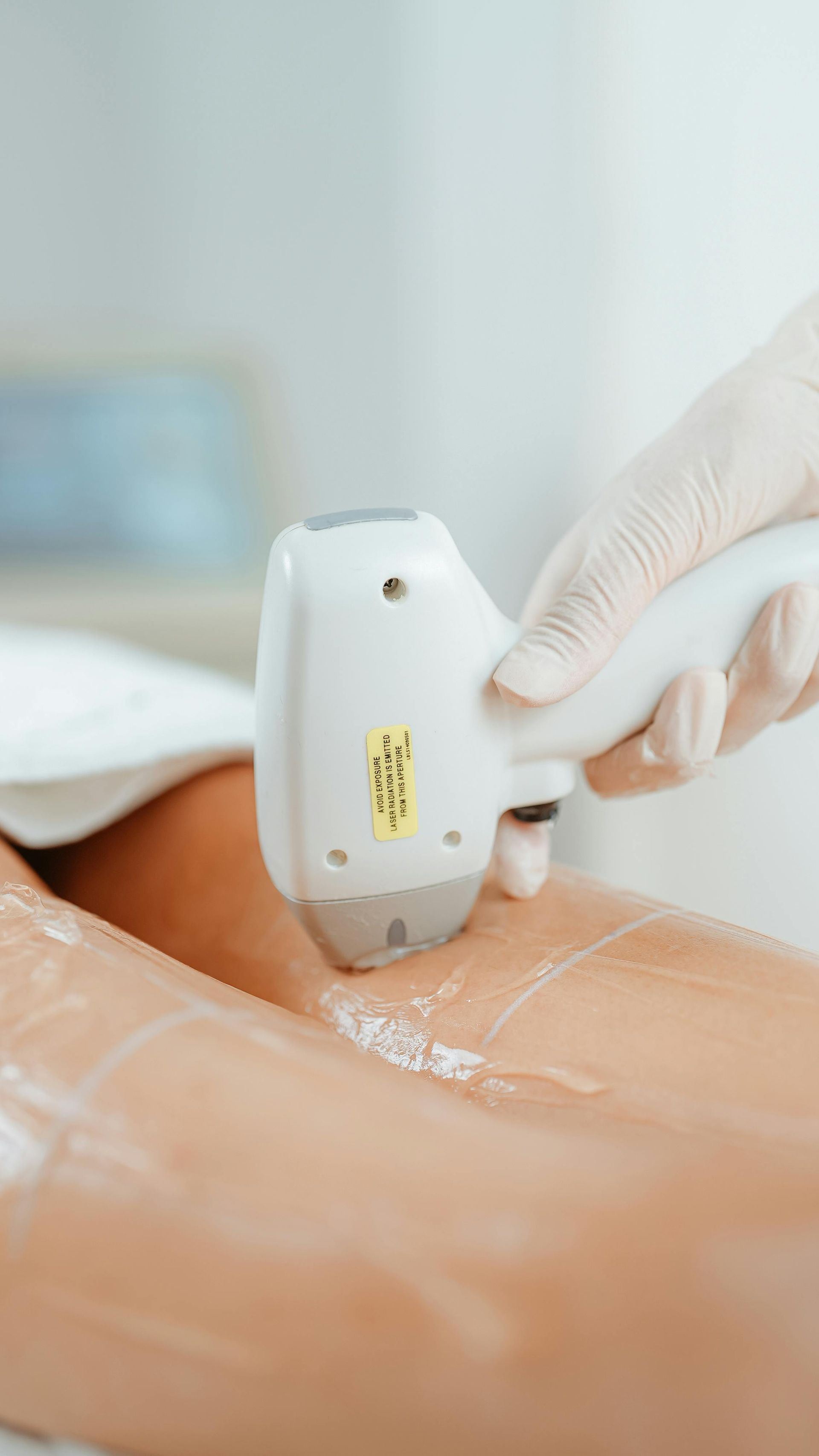 Une main gantée utilise un appareil d'épilation laser sur une jambe recouverte de gel rafraîchissant.