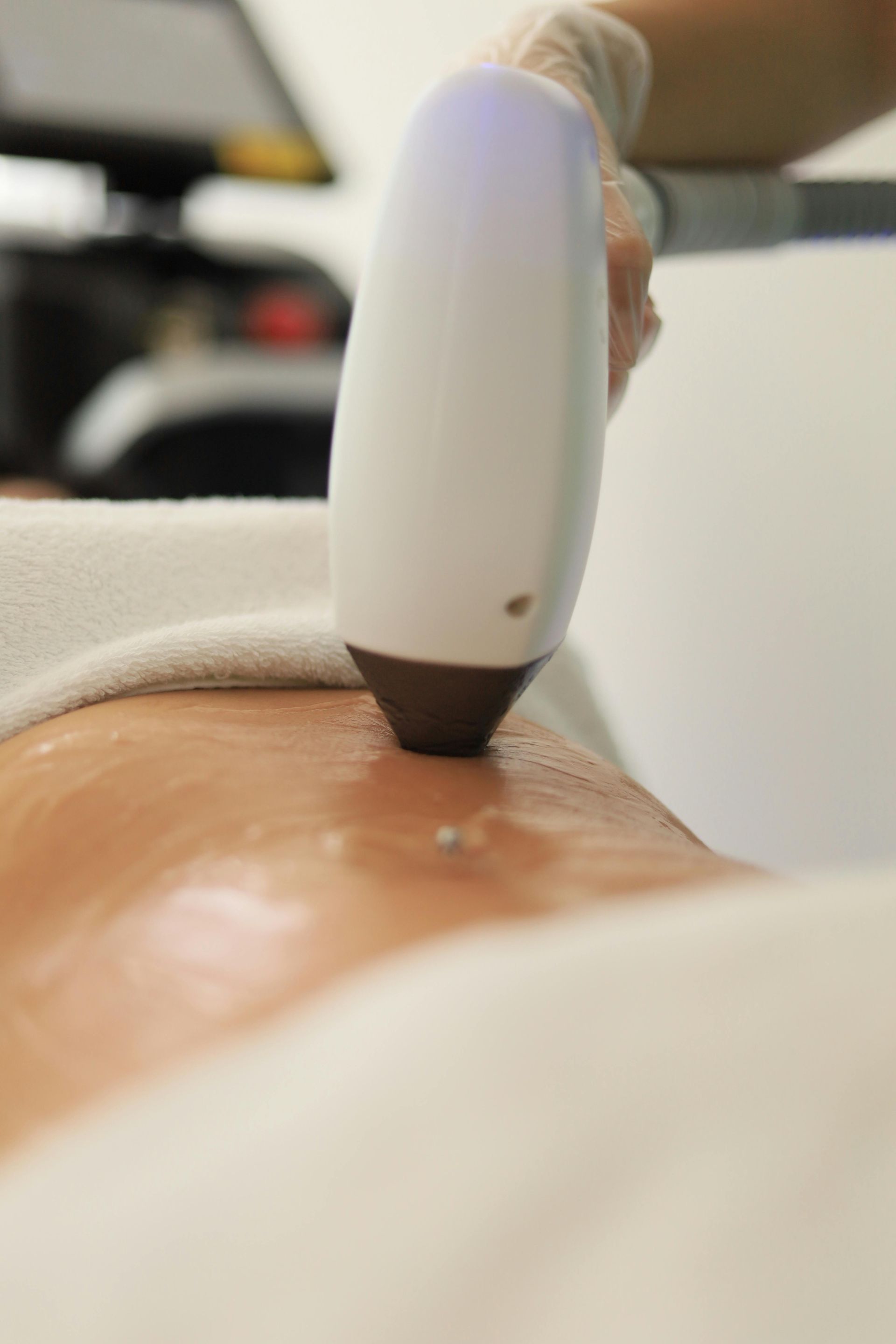 Un appareil d'épilation laser est appliqué sur une jambe recouverte d'une fine couche de gel rafraîchissant transparent.