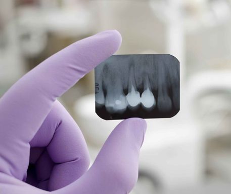 Mano enguantada de morado sosteniendo una radiografía dental que muestra los dientes sobre un fondo clínico borroso.