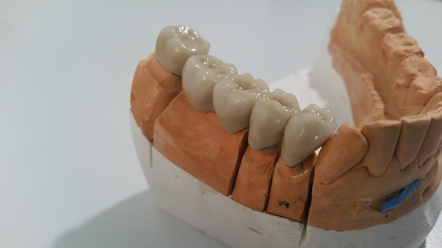 Zahnprothese - Zahnarztpraxis Bernegger - St. Gallen