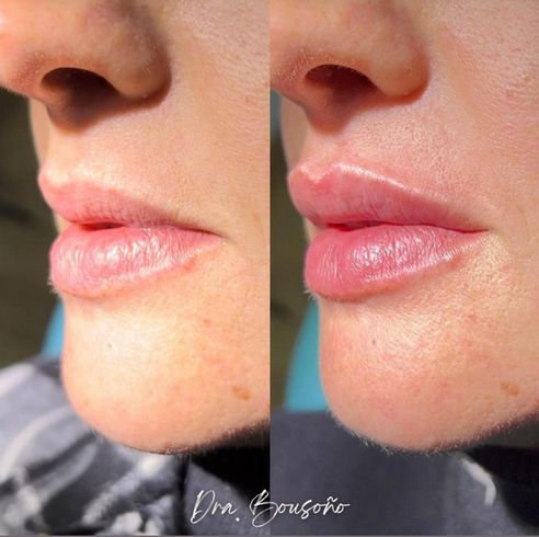 Antes y después del relleno de labios. Labios más voluminosos y con mejor forma tras el procedimiento cosmético.