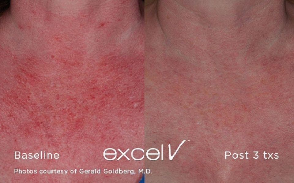 Une photo avant et après du cou d'une personne