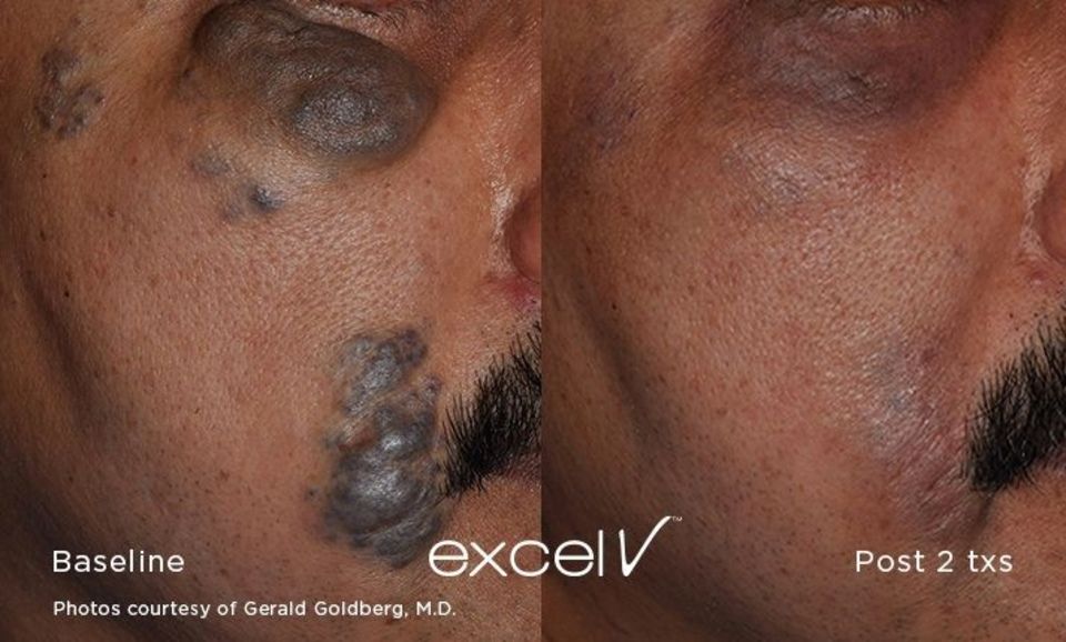 Une photo avant et après d'un visage d'homme avec une tache noire dessus.