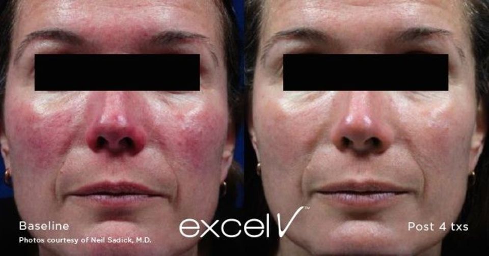 Une photo avant et après d'un visage de femme avec des taches rouges.