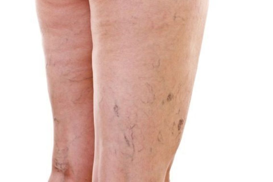 Les jambes d'une femme avec des varices