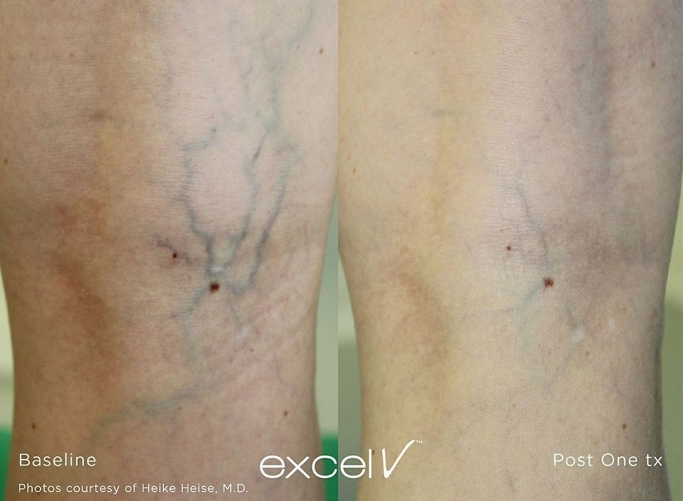 Une photo avant et après d'une jambe d'une personne présentant des varices