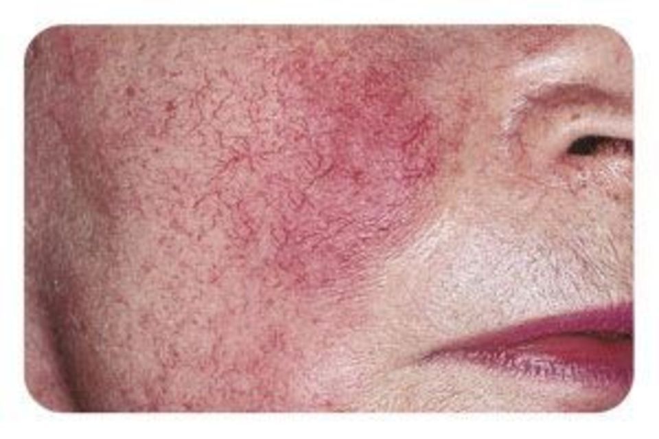 Un gros plan d'un visage de femme avec des veines rouges.