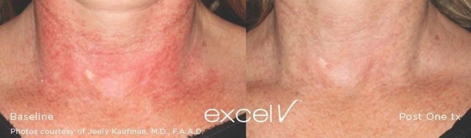 Une photo avant et après du cou et du décolleté d'une femme