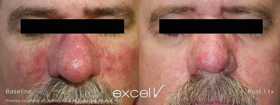 Une photo avant et après d'un visage d'homme avec des rougeurs.