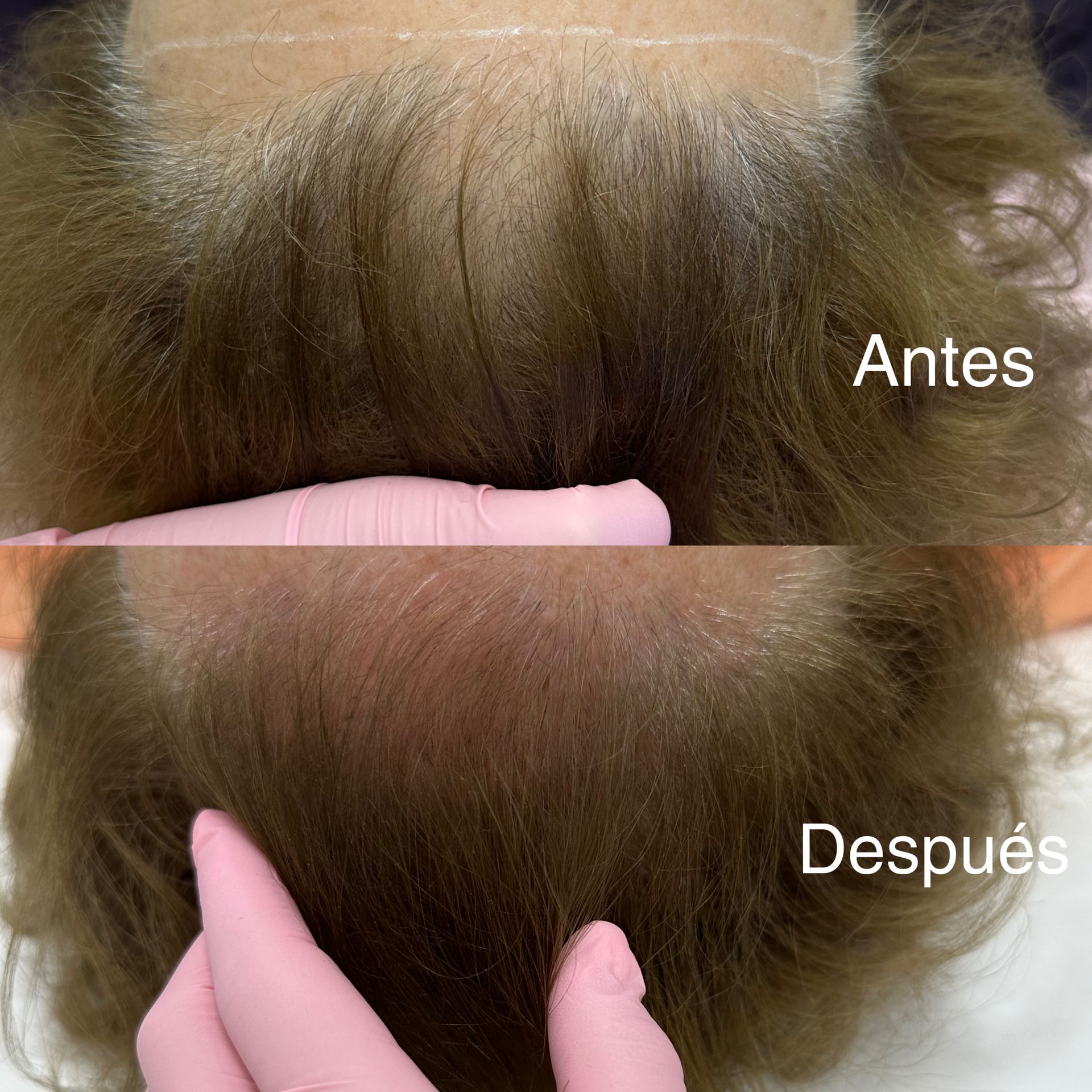 Antes y después de tratamiento con fusión plasma capilar