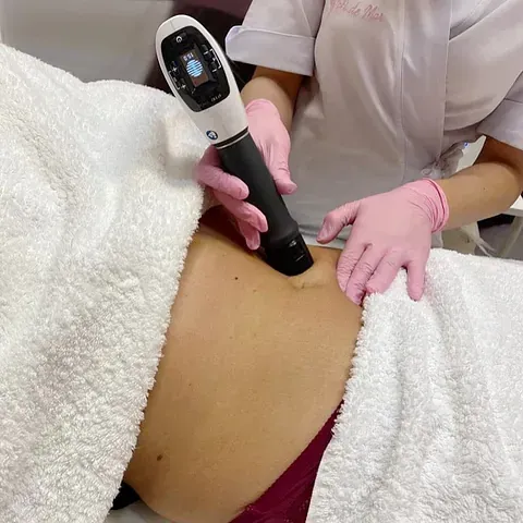 Tratamiento de Ondas de choque