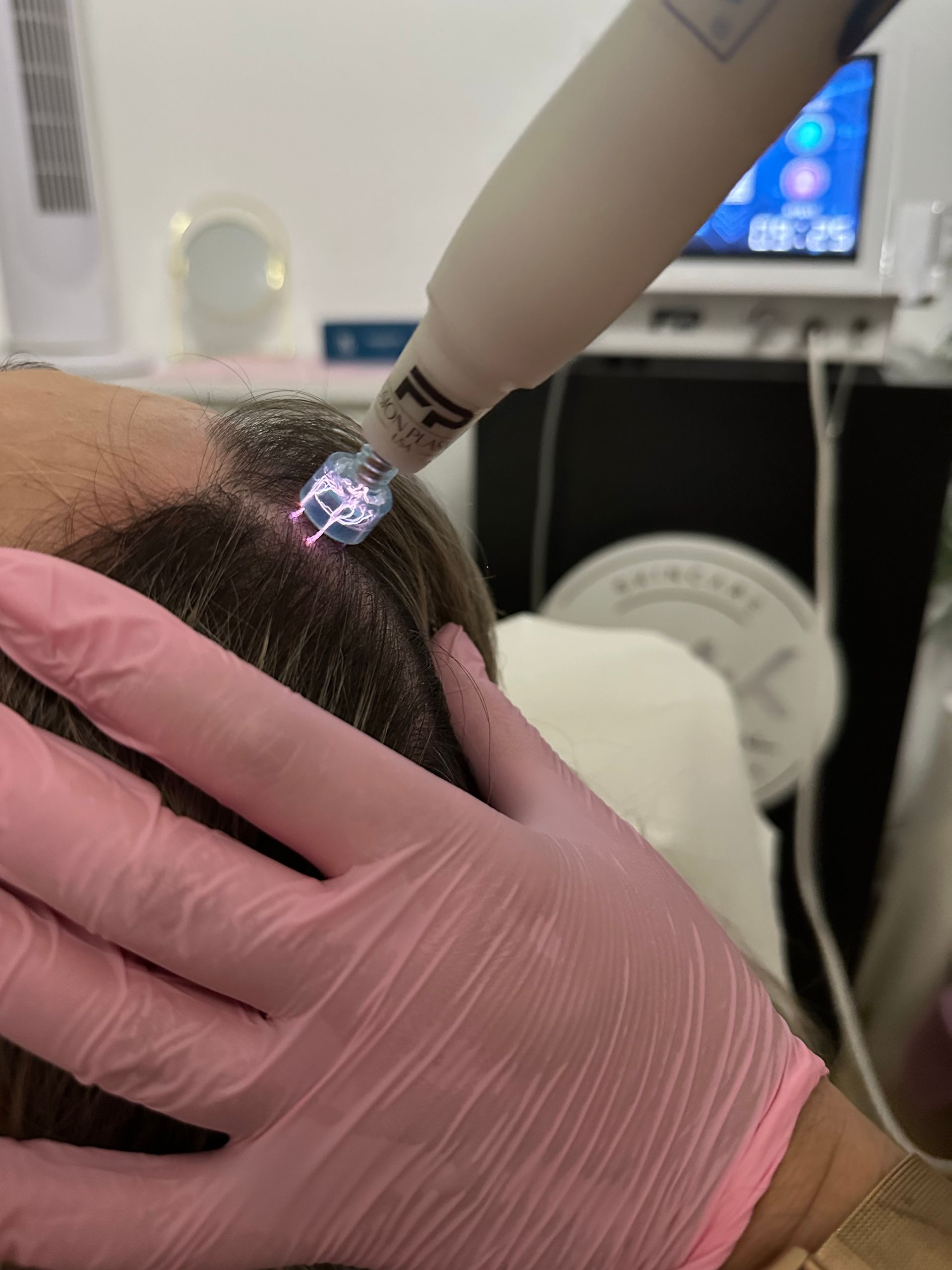 Persona con guantes sosteniendo un dispositivo que emite luz azul para fusión plasma capilar