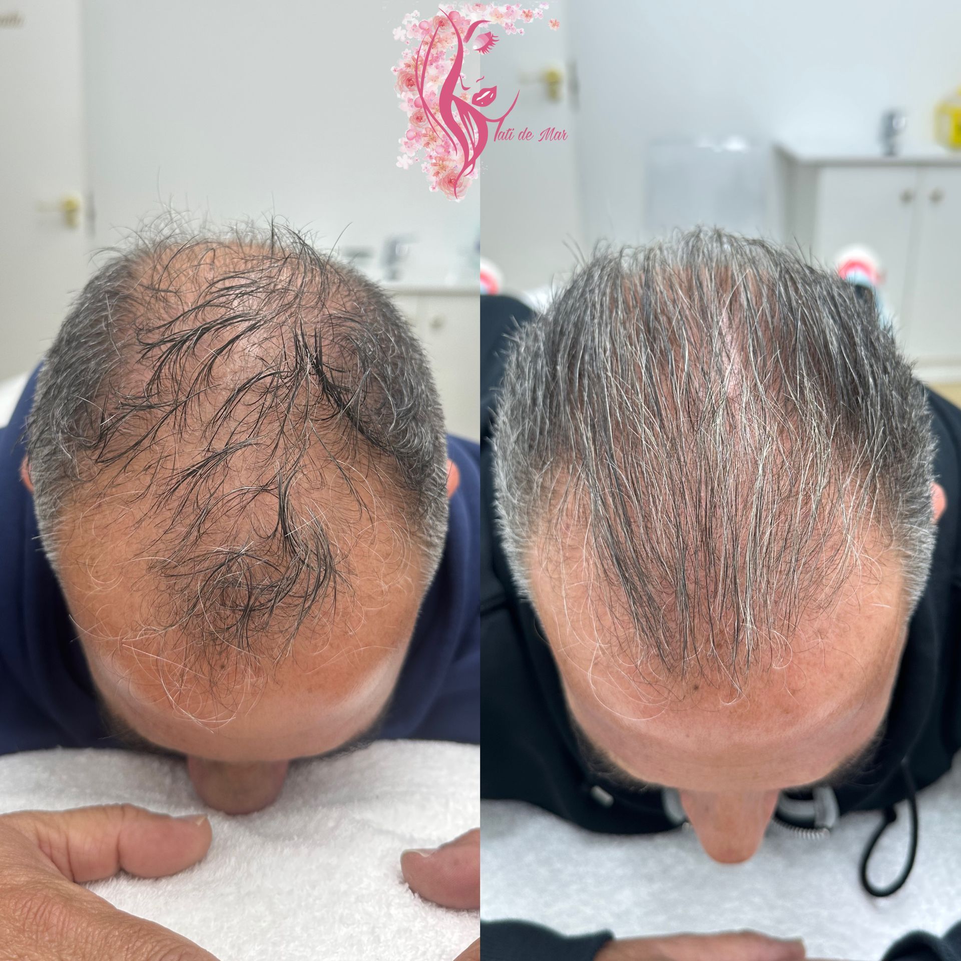 resultados en pelo del antes y después de tratamiento con fusión plasma capilar.