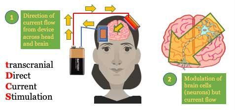 Διακρανιακός ηλεκτρικός ερεθισμός (transcranial direct current stimulation-tDCS)