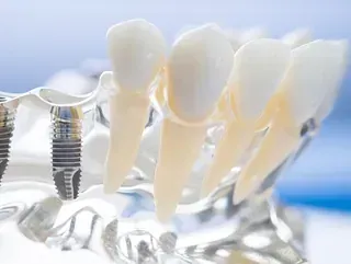 Un primer plano de un modelo de dientes con implantes dentales.