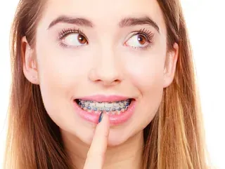 Un primer plano de una mujer joven con aparatos dentales.