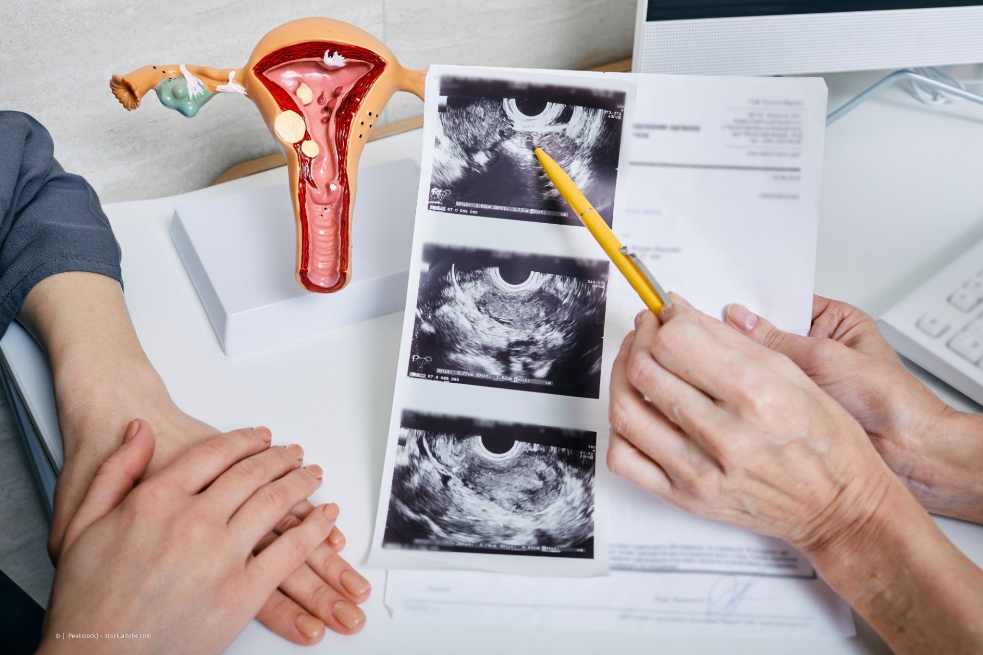 Ultraschallbilder bei der Frauenärztin