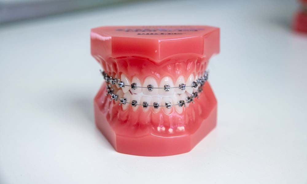 Gebissmodell mit Zahnspange