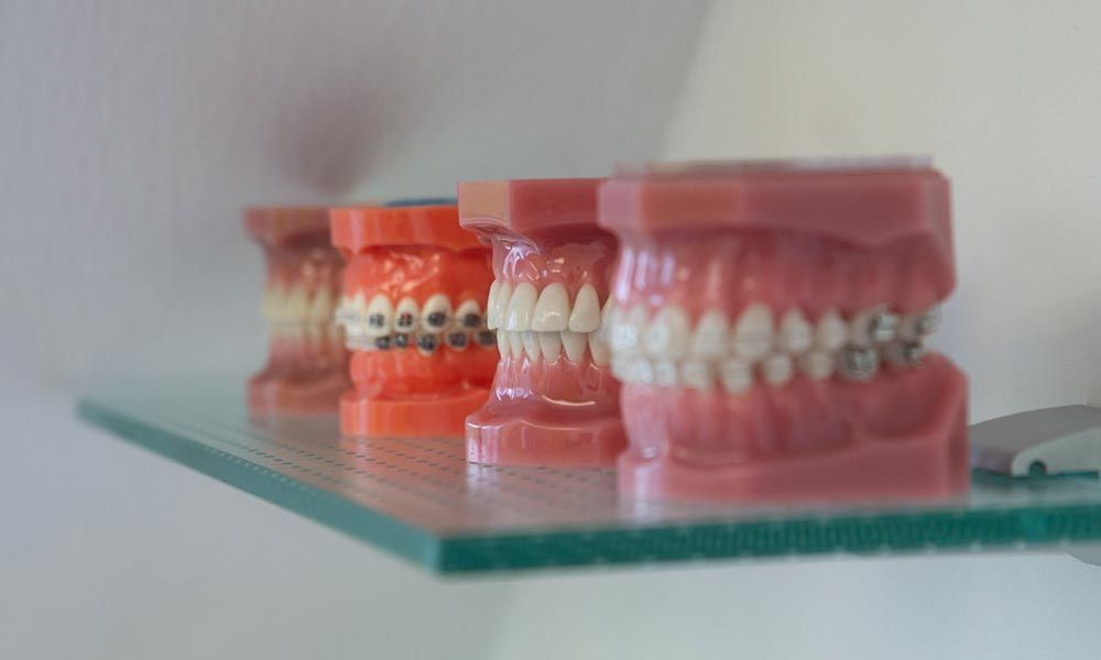 mehrere Gebissmodelle