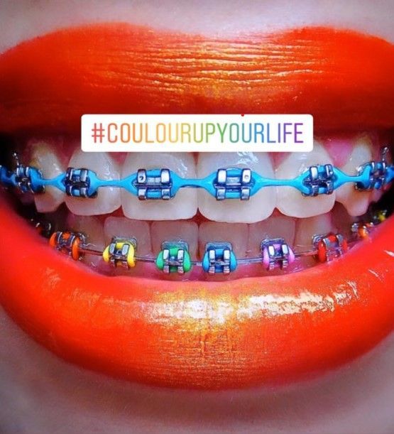 Zahnspange mit bunten Drähten