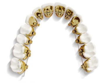 Modell von Gebiss mit innenliegender Zahnspange