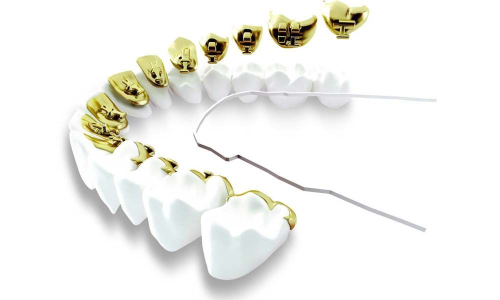 Modell von Gebiss, an dem eine innenliegende Zahnspange befestigt wird