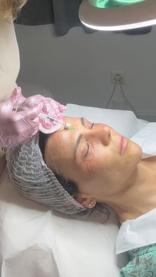 Donna che riceve un'iniezione al viso. Una mano guantata tiene un ago vicino al sopracciglio, in un ambiente clinico.