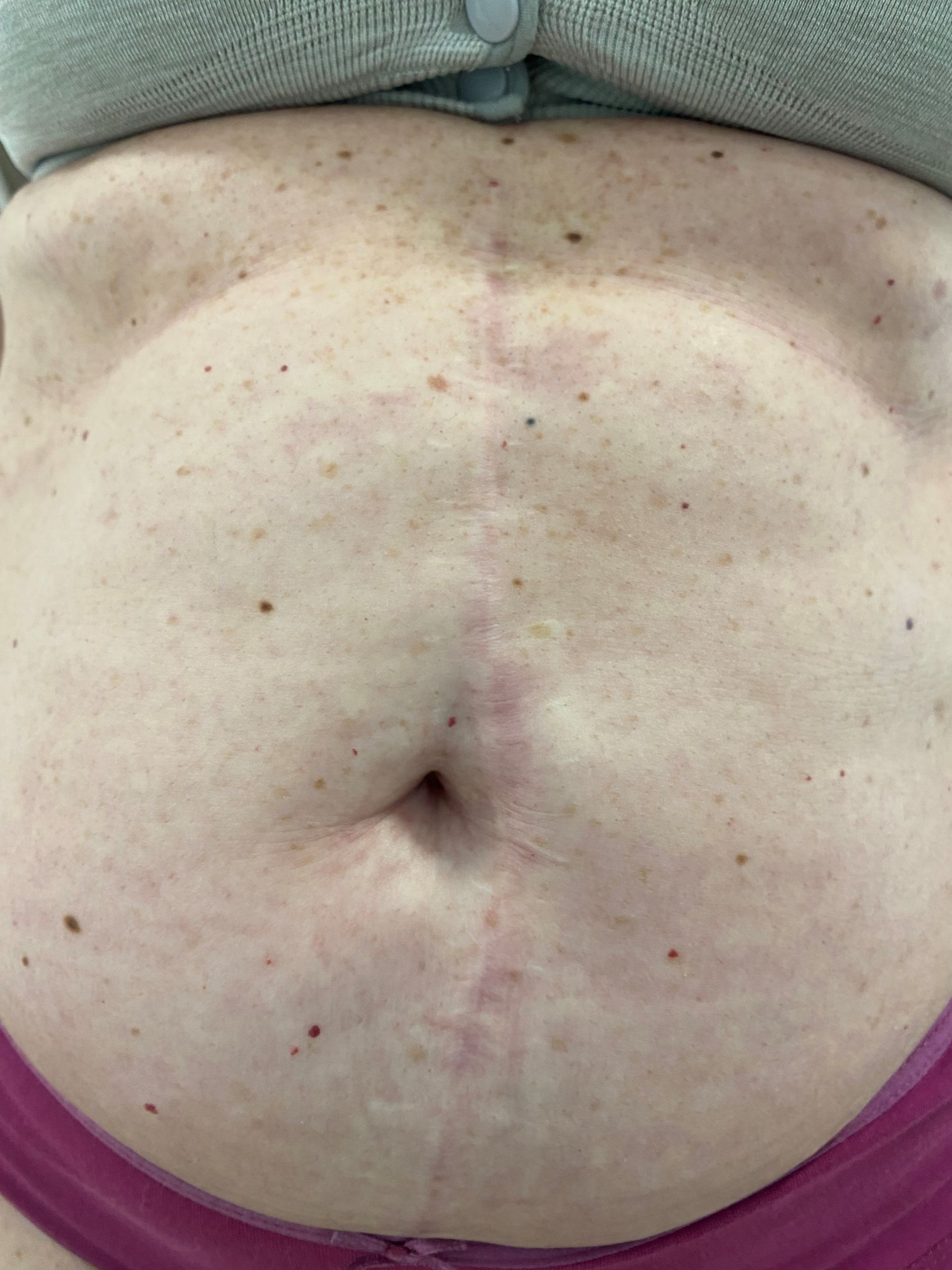 Copertura di una cicatrice con un tatuaggio