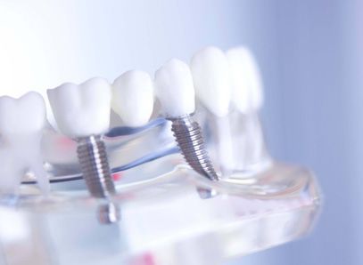 Implantes