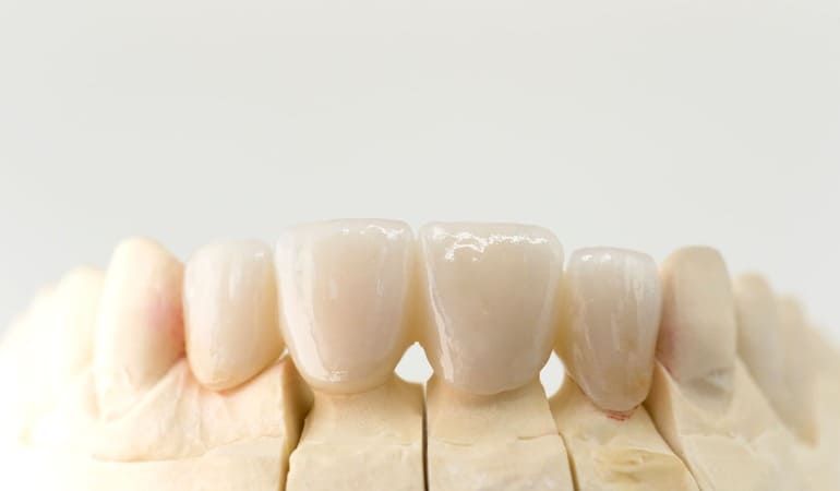 Eine Nahaufnahme eines Modells der Zähne einer Person auf weißem Hintergrund | Zahnmedizin am Neckar