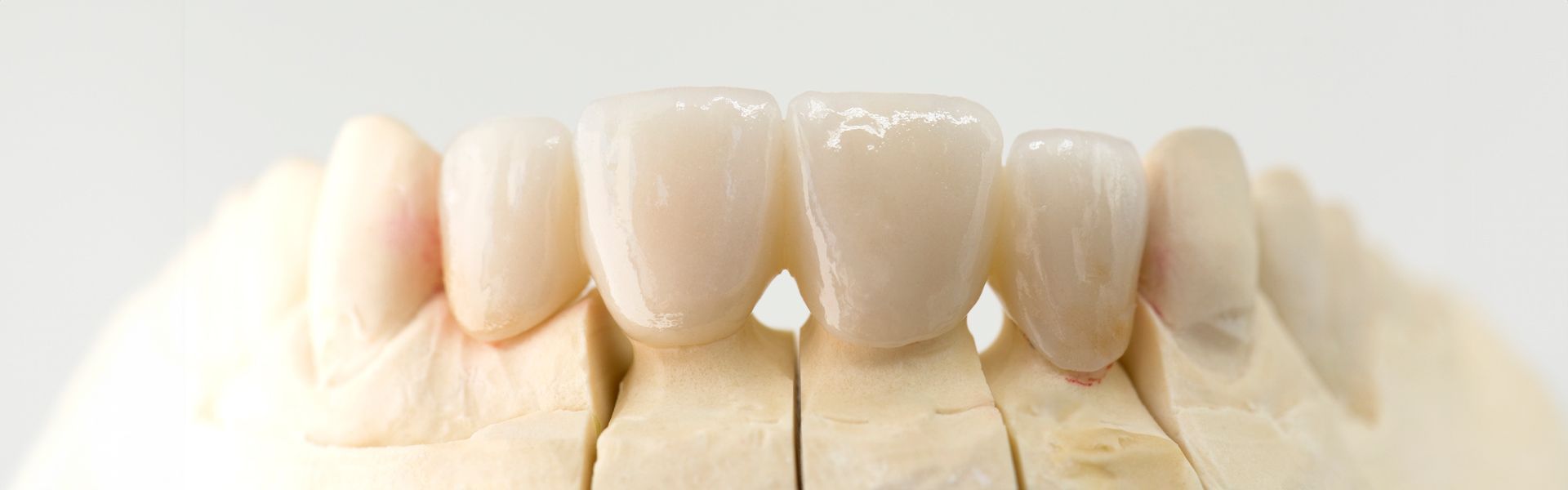 Eine Nahaufnahme eines Modells der Zähne einer Person auf weißem Hintergrund | Zahnmedizin am Neckar
